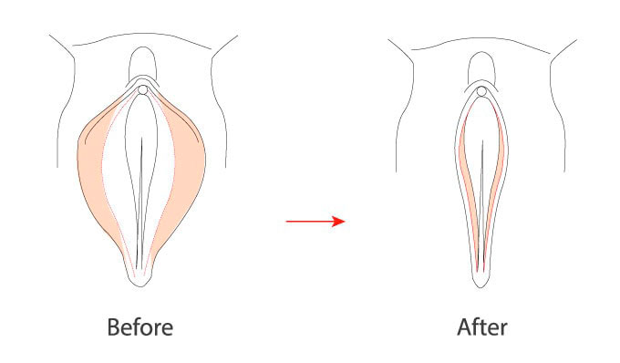 labiaplasty-schematic-1 labiaplasty-schematic-1